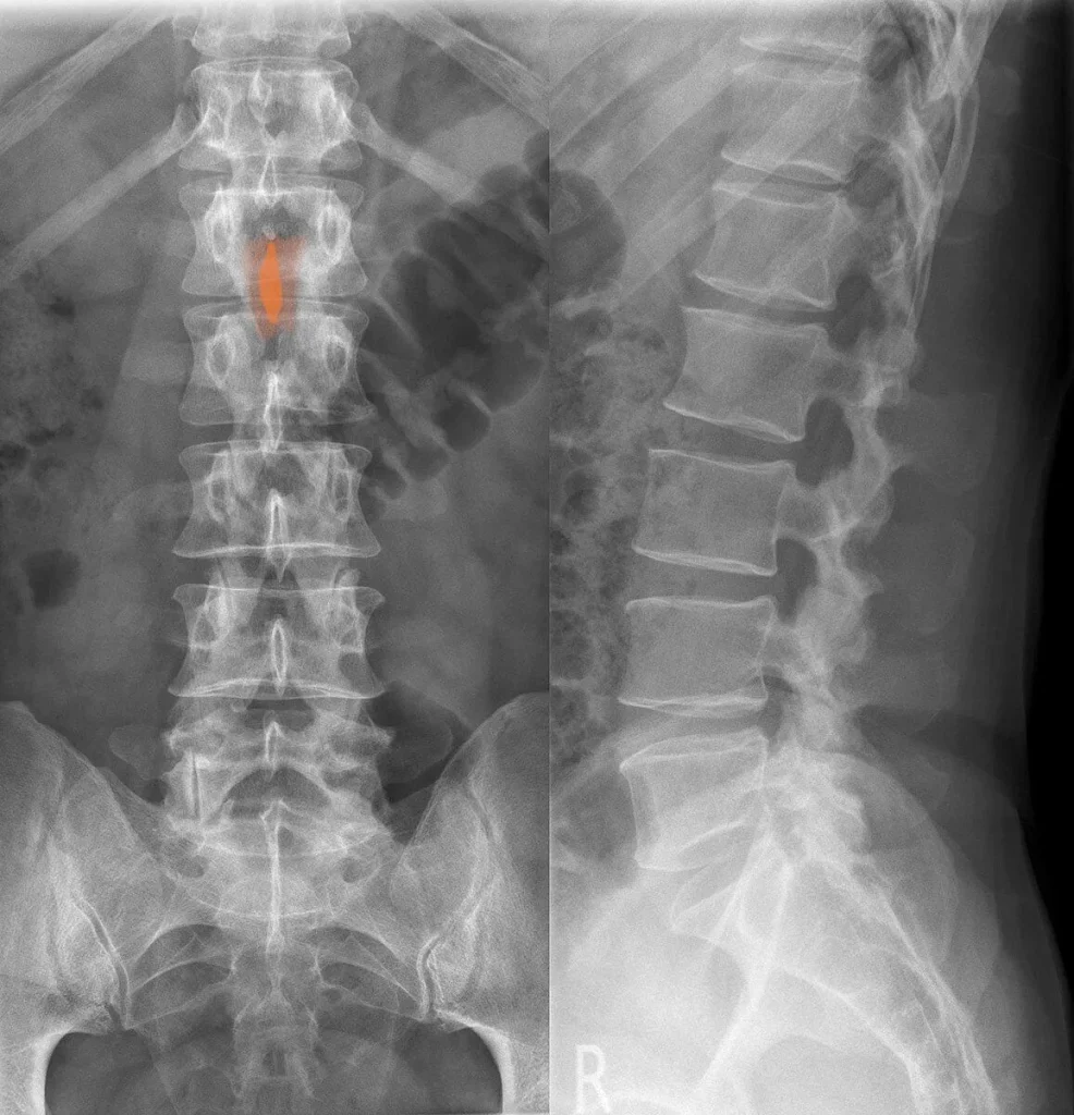 Laminectomy Fluro.jpg