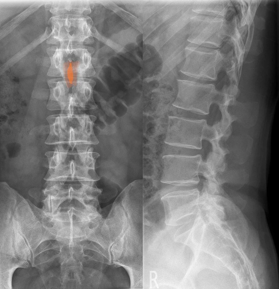 Laminectomy Fluro.jpg