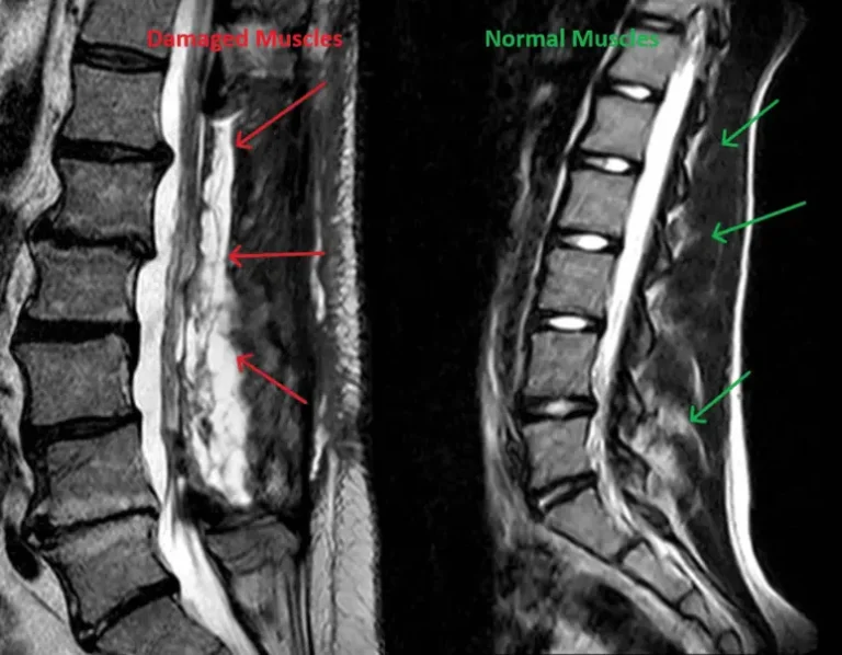 Laminectomy_Muscle_Damage