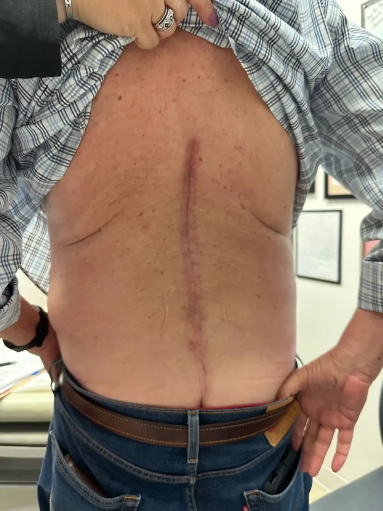 A person lifts their shirt to reveal a large, vertical scar on their back.
