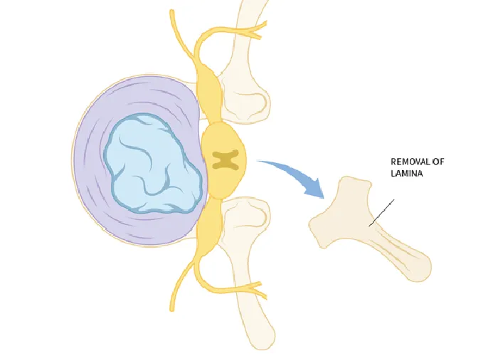 Illustration showing a spine with a removed lamina section.