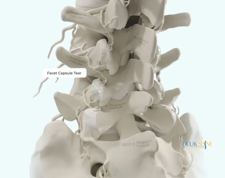 Illustration of a spine highlighting a facet capsule tear.