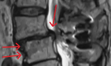 MRI scan showing spinal discs with red arrows pointing to areas of interest.