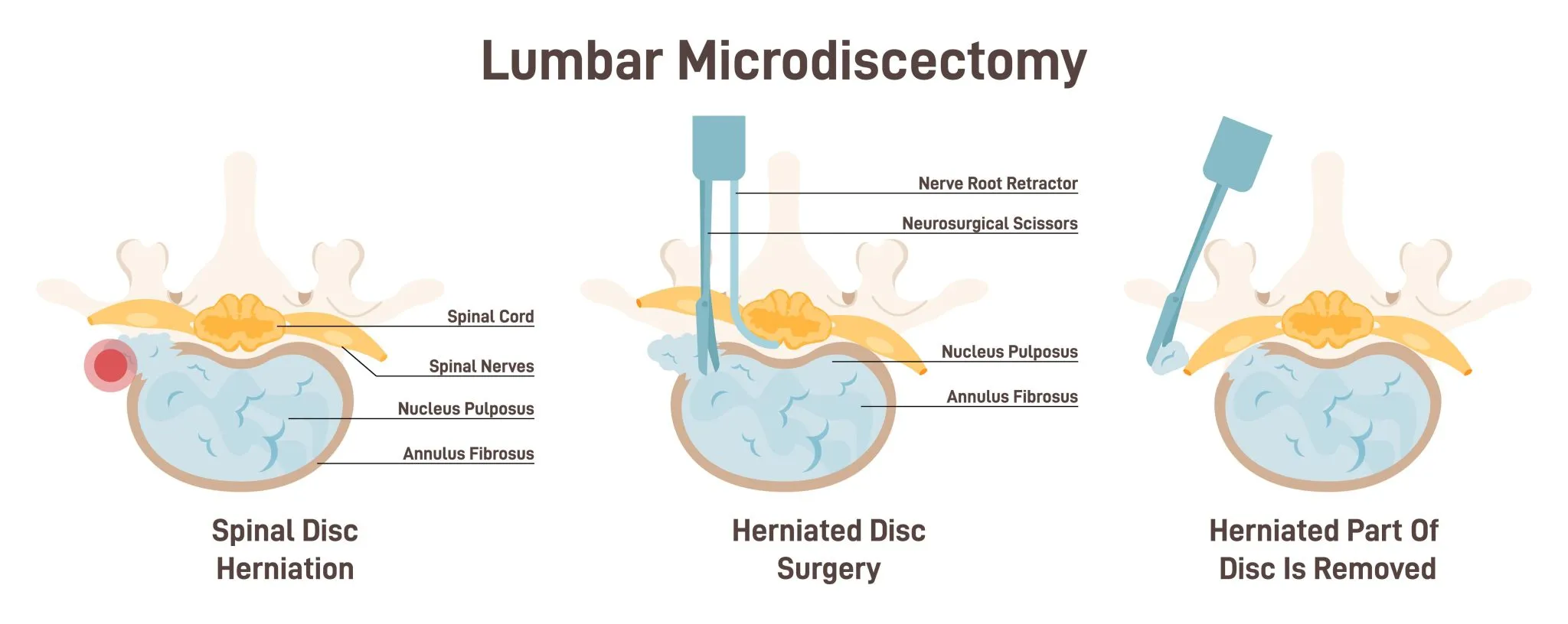 Lumbar Microdiscectomy-TitleImage.jpg