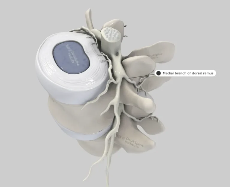 D model of a vertebra showing the medial branch of the dorsal ramus nerve.