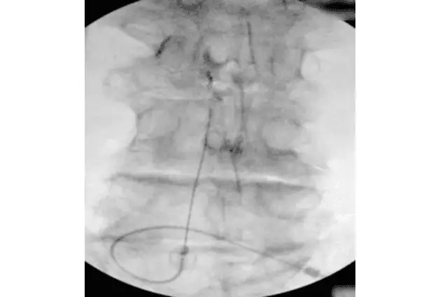 X-ray image showing a looped catheter within the spinal area.