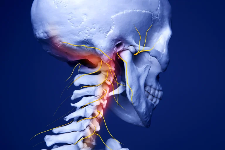 Side view of a human skull and cervical spine highlighting nerves in yellow and an area of inflammation in red.