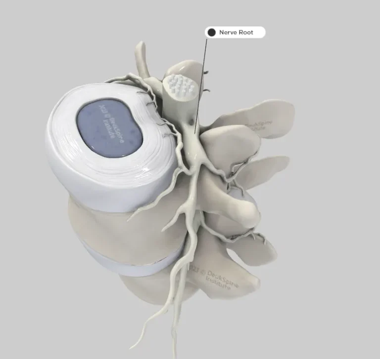 Cross-section of a spine showing a labeled nerve root.