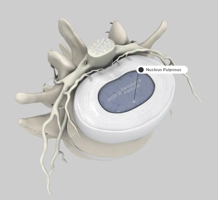 D model of a spinal disc cross-section showing the nucleus pulposus labeled.