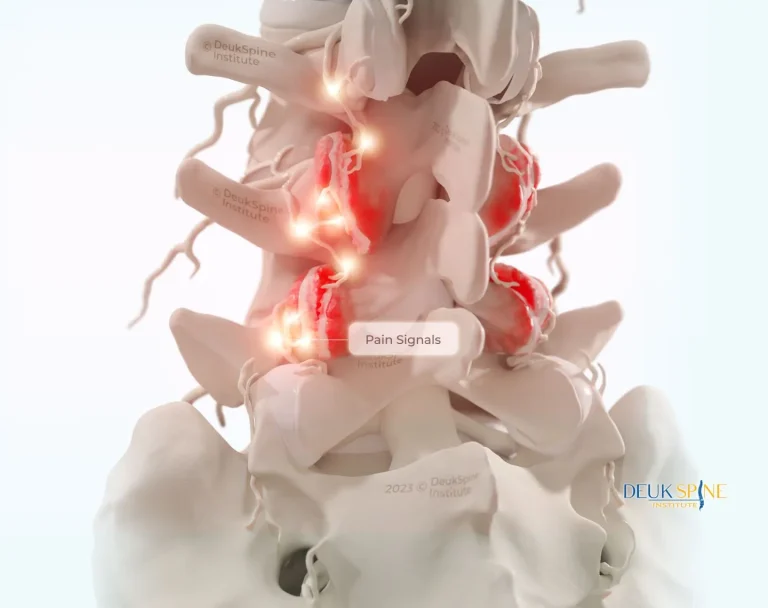Medical illustration showing lumbar spine with highlighted pain signals.