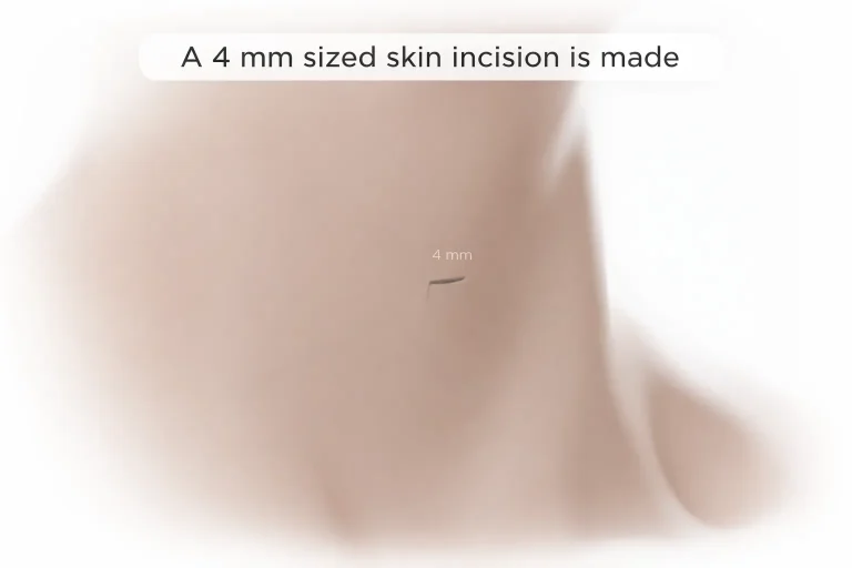 Close-up of a 4 mm skin incision with descriptive text above.