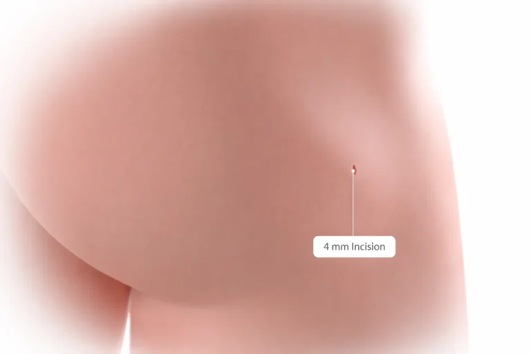 Close-up of a hip with a labeled 4 mm incision.