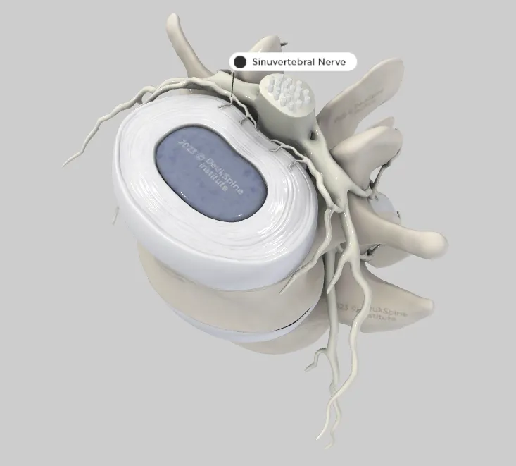 D model of a vertebra with highlighted sinuvertebral nerve and labeled structures.