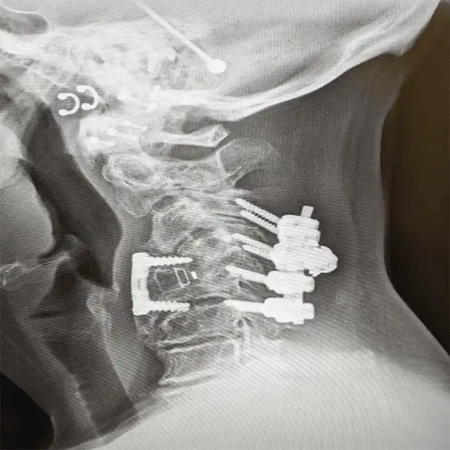 X-ray of a neck with spinal implants and screws visible.