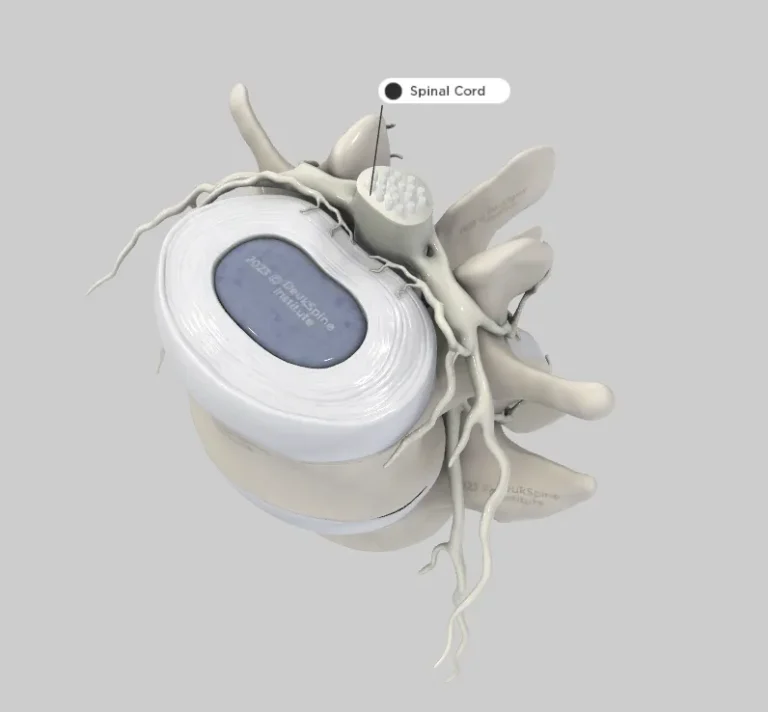 D model of a spinal disc with protruding nerves, labeled "Spinal Cord.