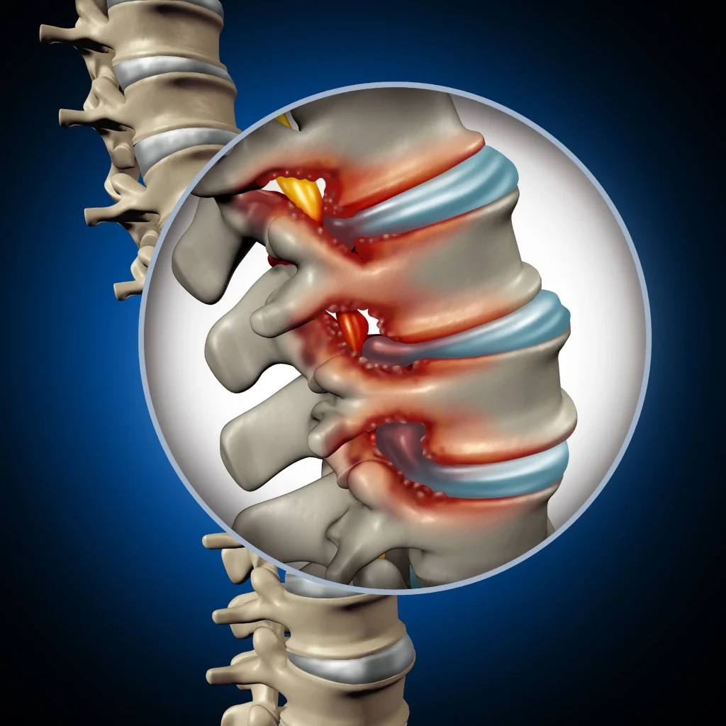 Illustration of a spine segment highlighting inflamed discs and nerves.