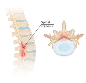 Illustration of herniated disc with inflamed area and cross-section view of spine.