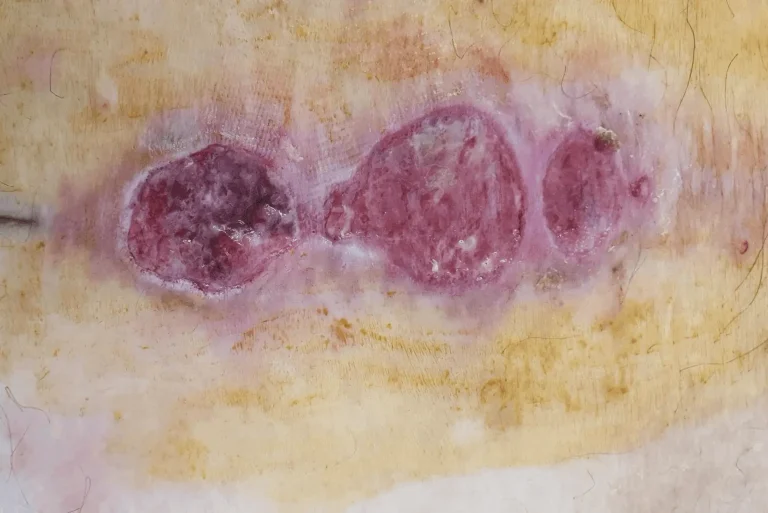 Three infected sores on skin with redness and discoloration.