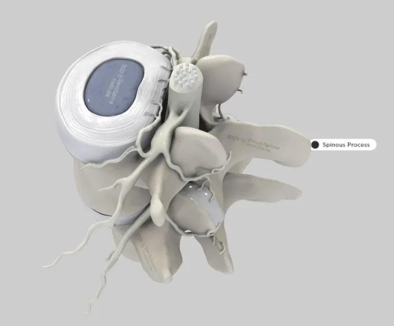 D model of a spinal vertebra with labeled spinous process and visible nerves.