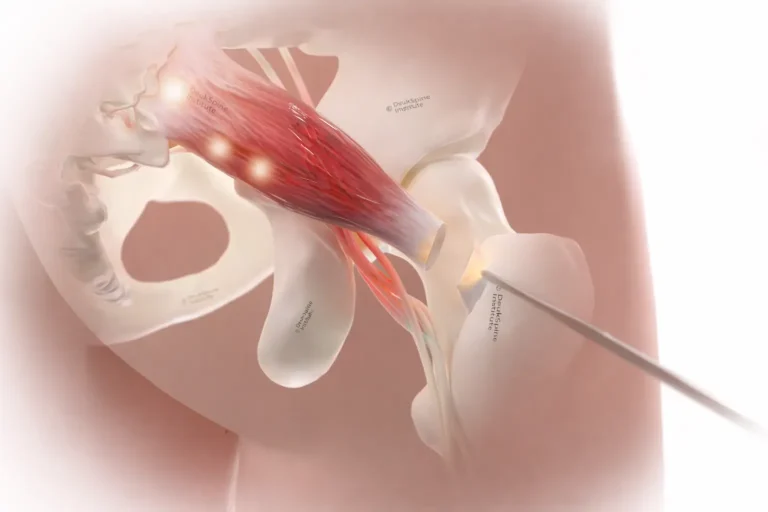 Illustration of a surgical needle near a hip joint with visible muscles and nerves.