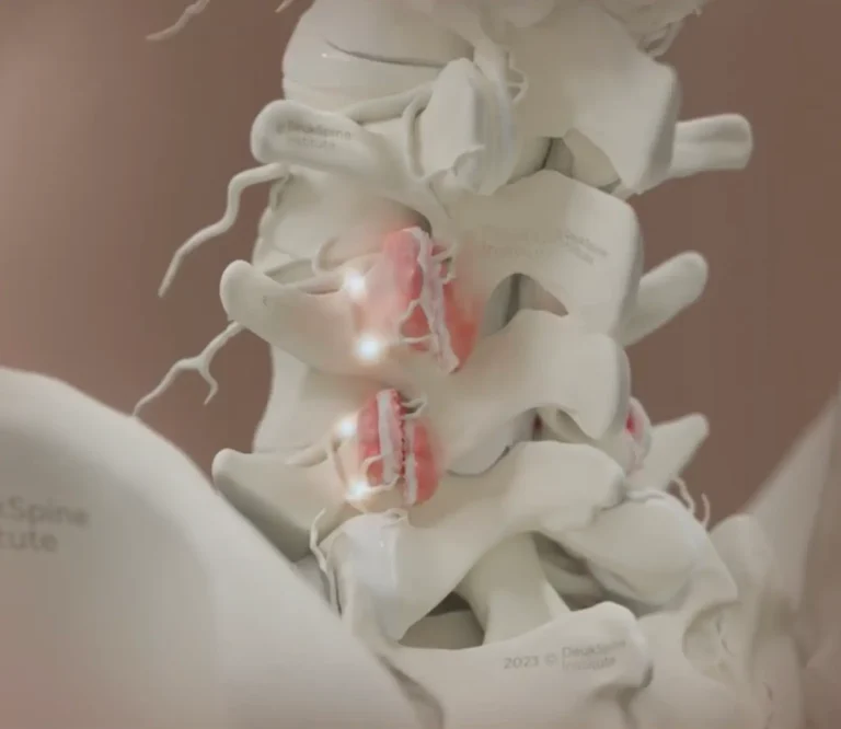 Close-up of a spine model showing inflamed, highlighted intervertebral discs.