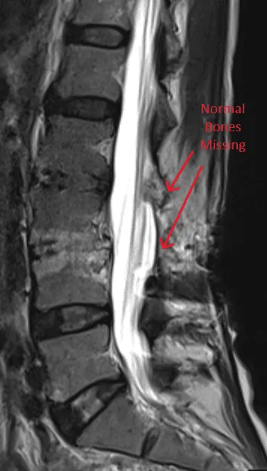MRI of the spine showing missing vertebrae, marked by red arrows.