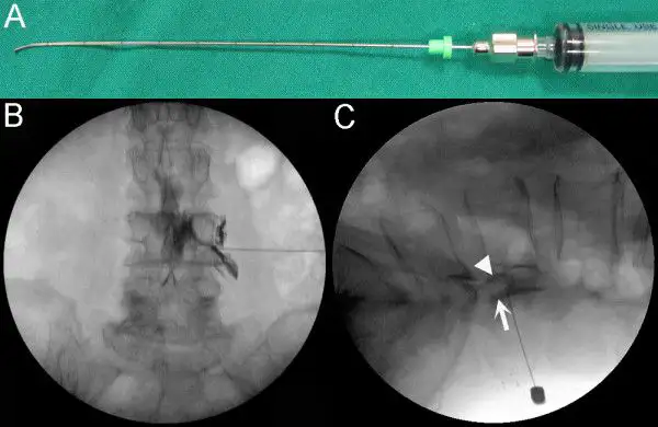 Three-panel medical image showing a syringe and two X-rays of a spinal procedure.