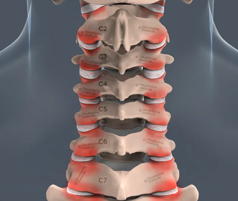 Illustration of seven cervical vertebrae with highlighted red areas.