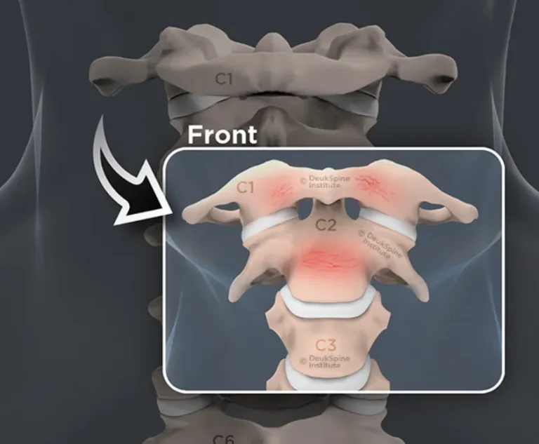 Illustration of C1 to C3 vertebrae highlighting areas with red marks.