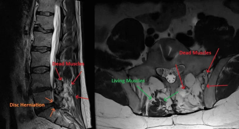 MRI scans showing disc herniation, dead muscles in red, and living muscles in green.