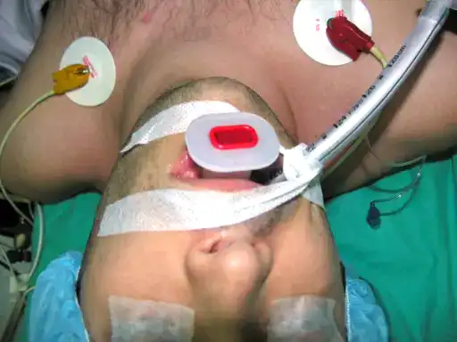 Person intubated with monitoring electrodes on chest, lying on a medical bed.