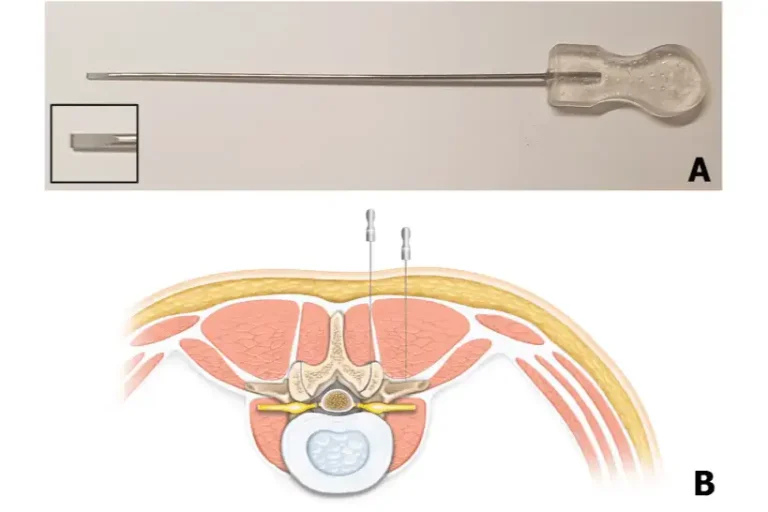Needle tool and diagram showing spinal muscle anatomy with insertion points.
