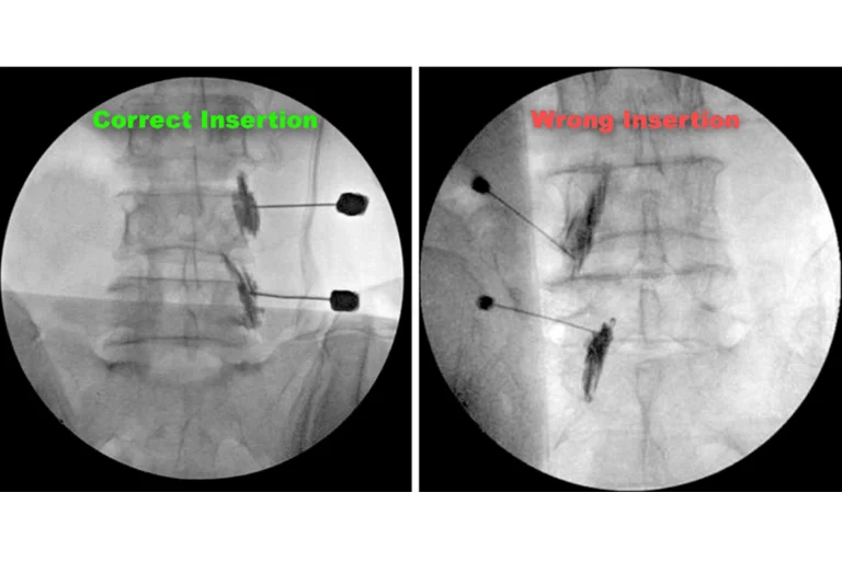 Side-by-side X-rays of correct and incorrect spinal needle insertions, labeled accordingly.