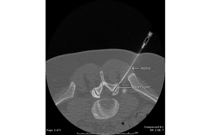 CT scan showing a needle inserted into the facet joint of the spine.