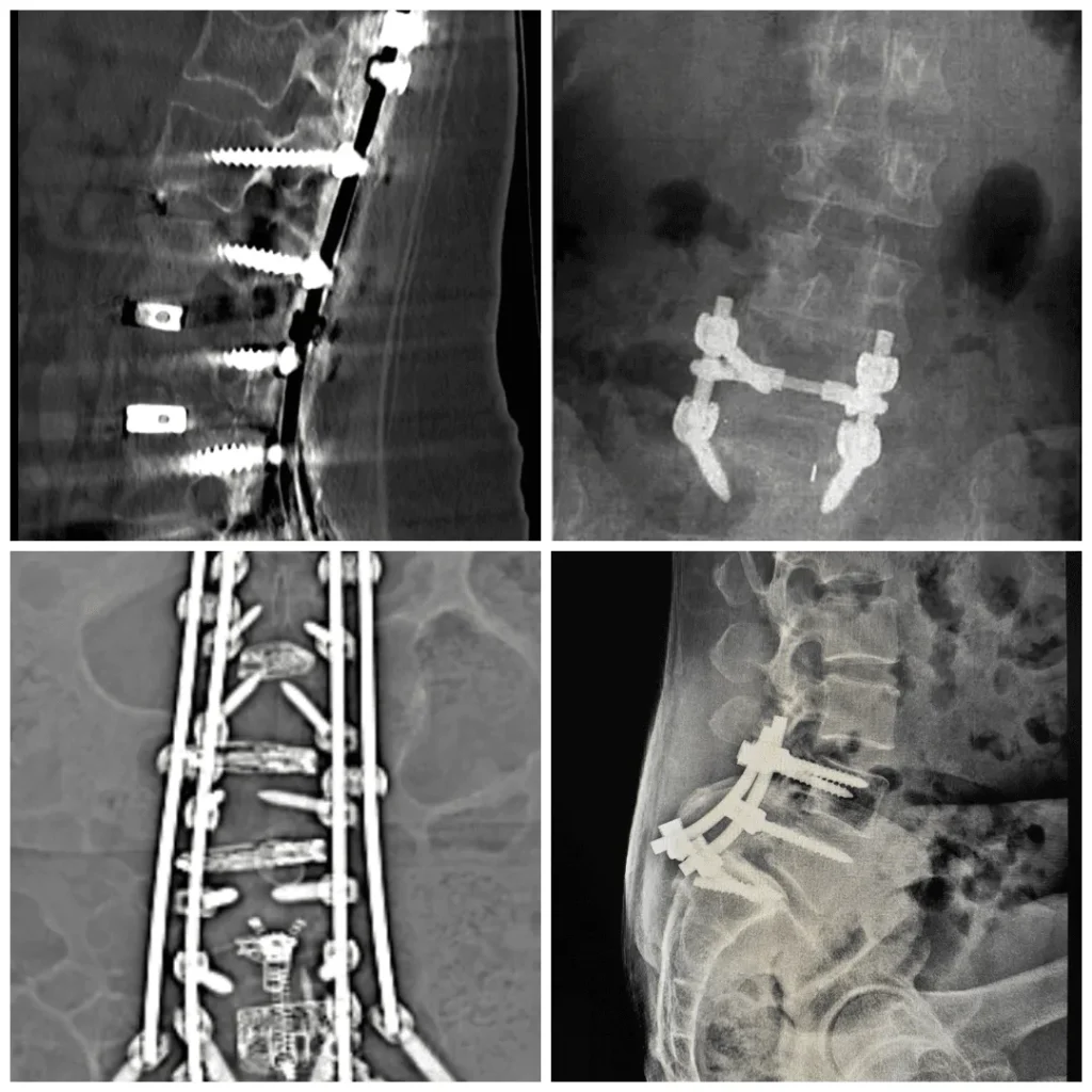 X-ray images showing spinal surgeries with metal implants and rods.