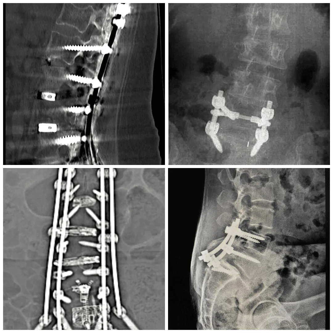 collage of x-rays of 2-4 level spinal fusion surgeries