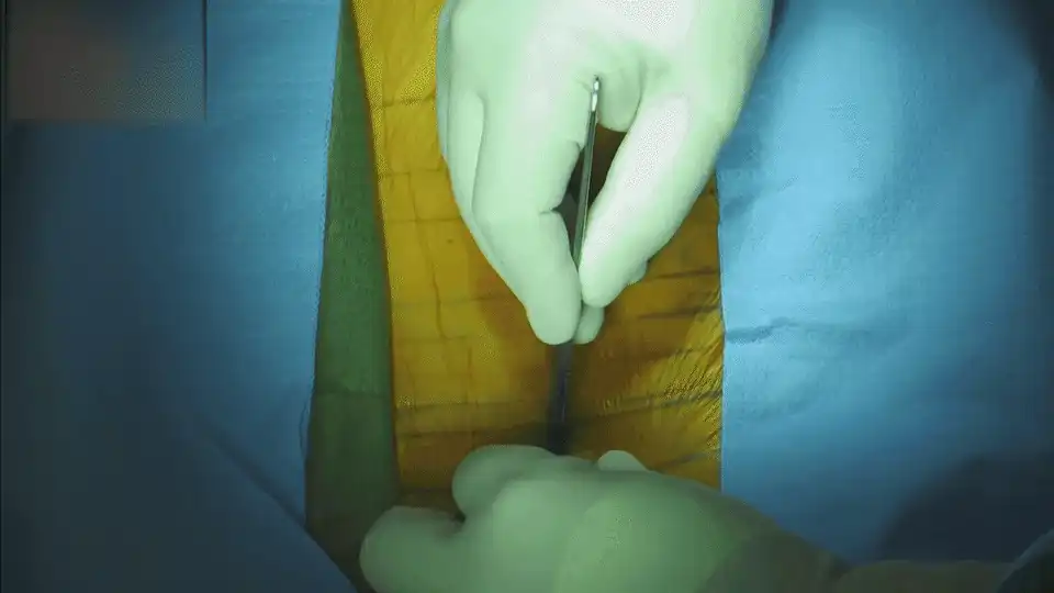 #1 Large Skin Incision GIF.gif