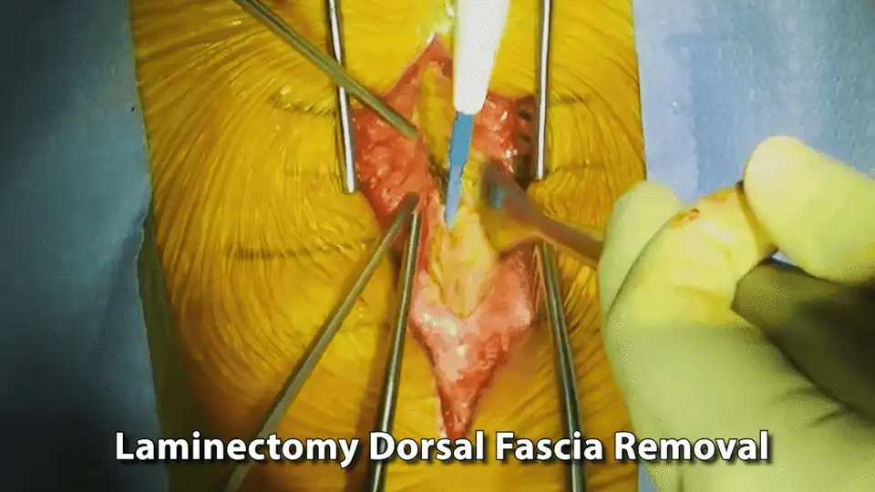 #2 Remove Dorsal Fascia GIF.gif