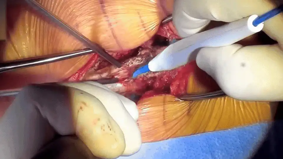 #3 Remove muscles from Spine GIF.gif