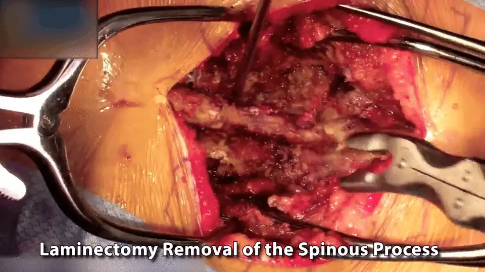 #4 Remove Spinous process.gif