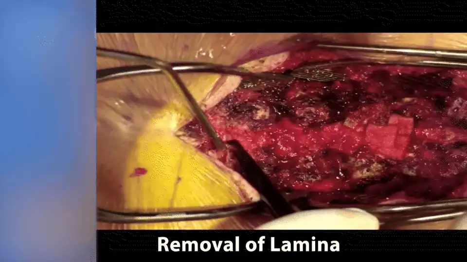 #5 Remove Lamina (laminectomy) and ligamentum flavum GIF.gif