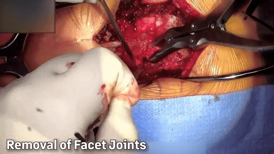 #6 Removal of Facet Joints GIF.gif