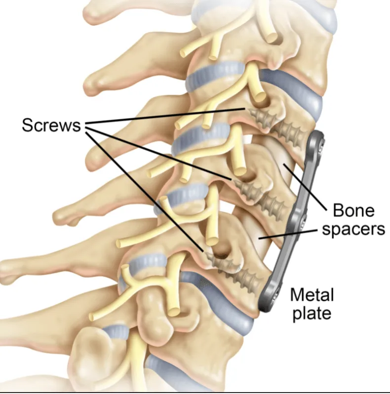 Illustration of spinal fusion surgery with screws, bone spacers, and metal plate.
