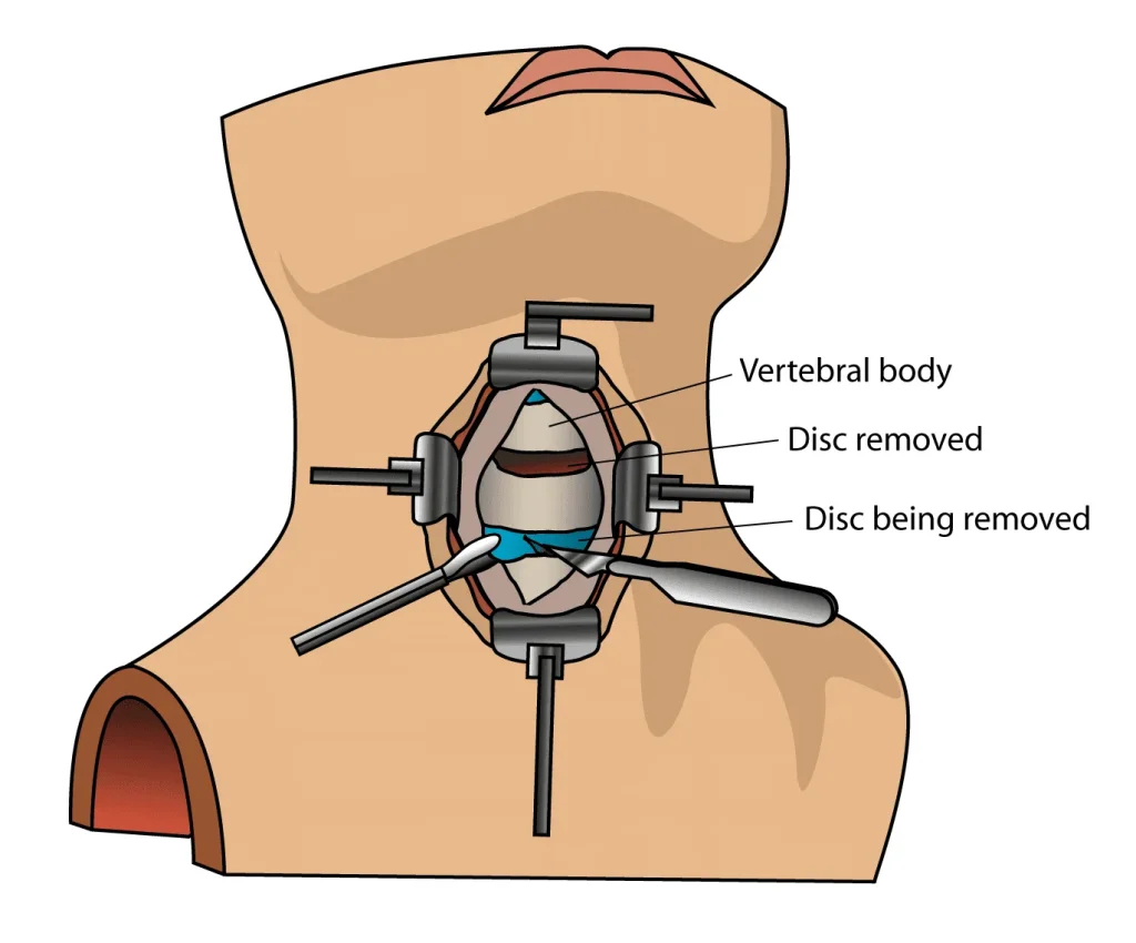 Illustration of an anterior cervical discectomy showing disc removal.