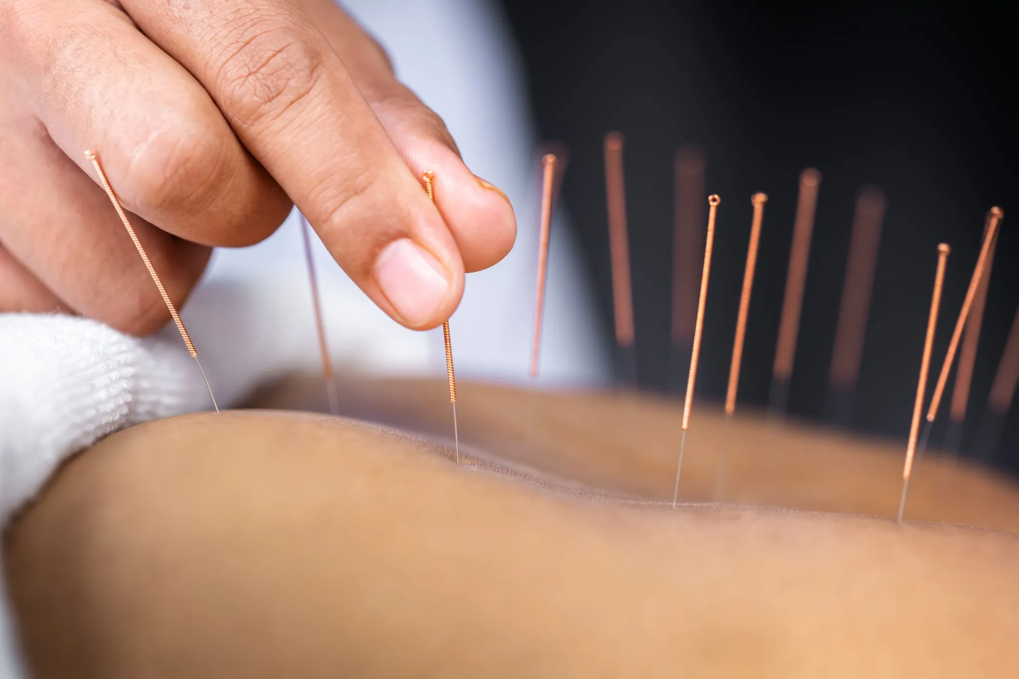 Acupuncture being applied to back