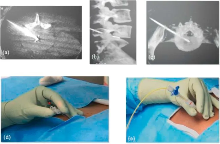 Example of a radiofrequency ablation to treat back pain