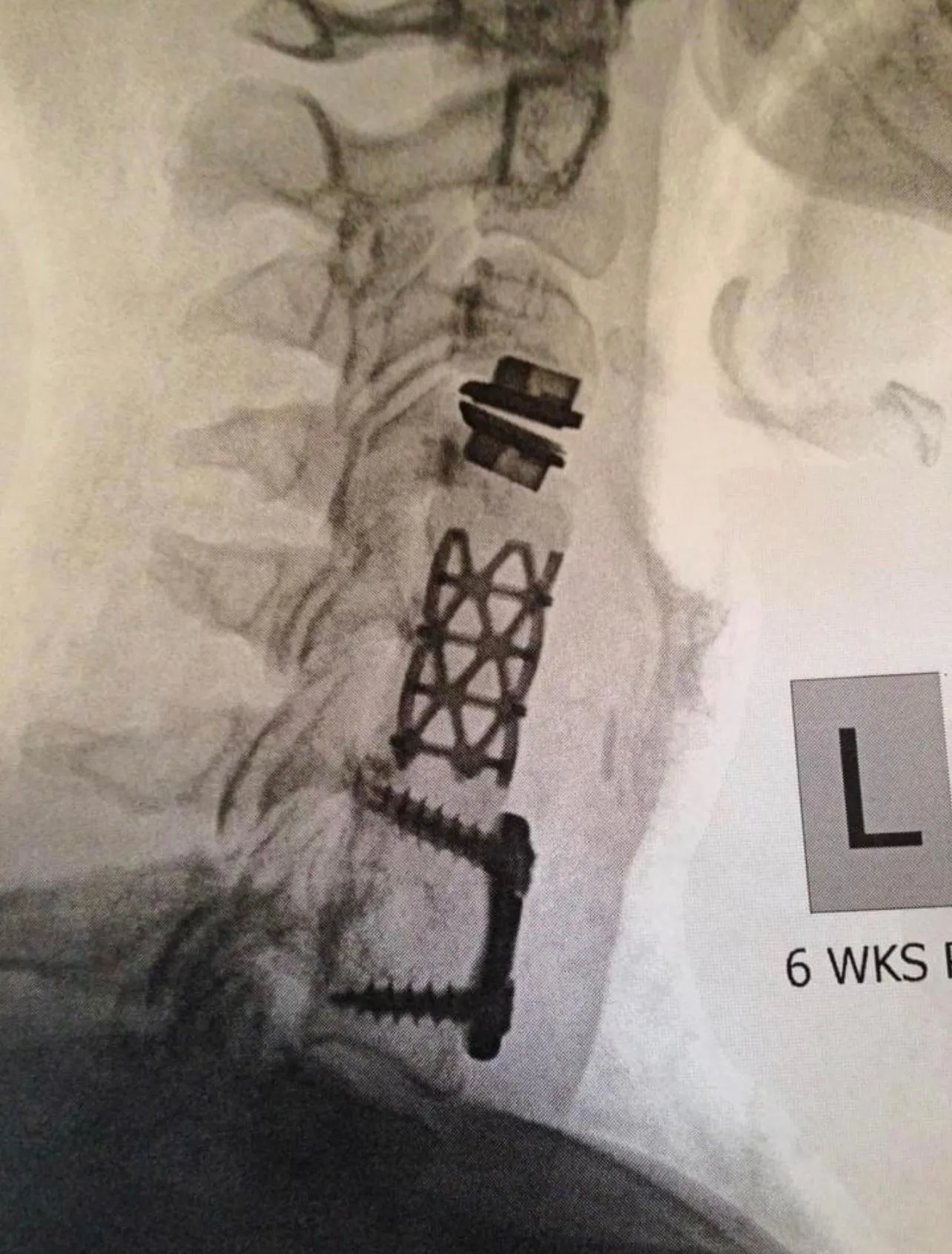 #Artificial Discs #Fusion #Adjacent Segment Disease #XRay #Lumbar #Complications-IMG_3045.jpg