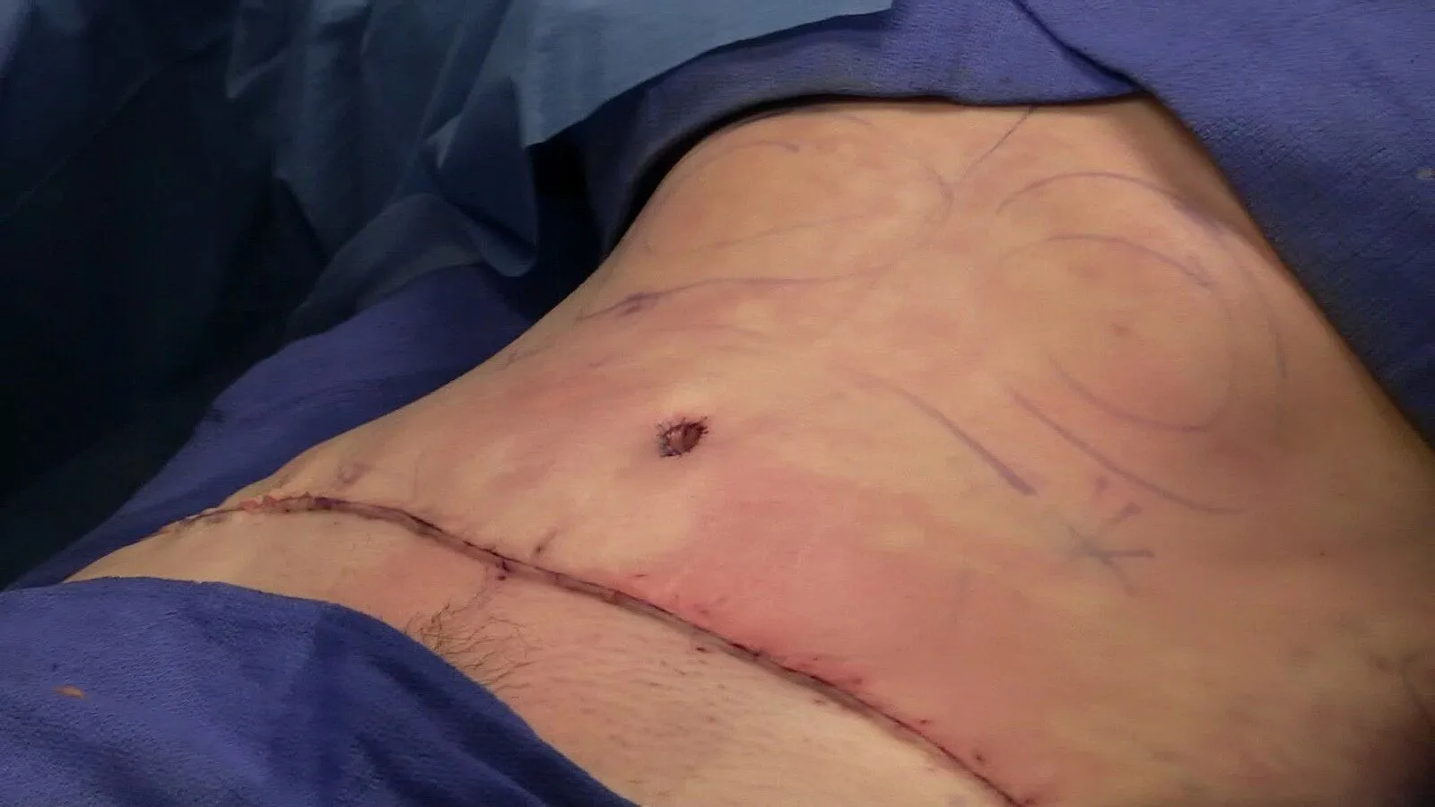 Back Surgery through abdomen.jpg