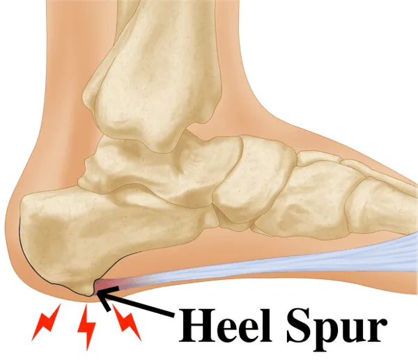 Illustration of a heel spur on a human foot, highlighting bone growth and pain points.