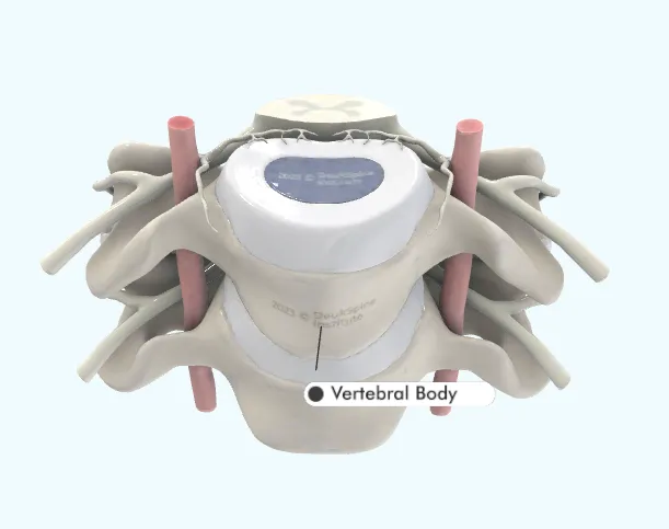 D model of a vertebral body with highlighted areas and labels.